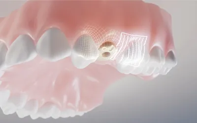 CAMLOG Biotechnologies – Gingividuals Marketing Video